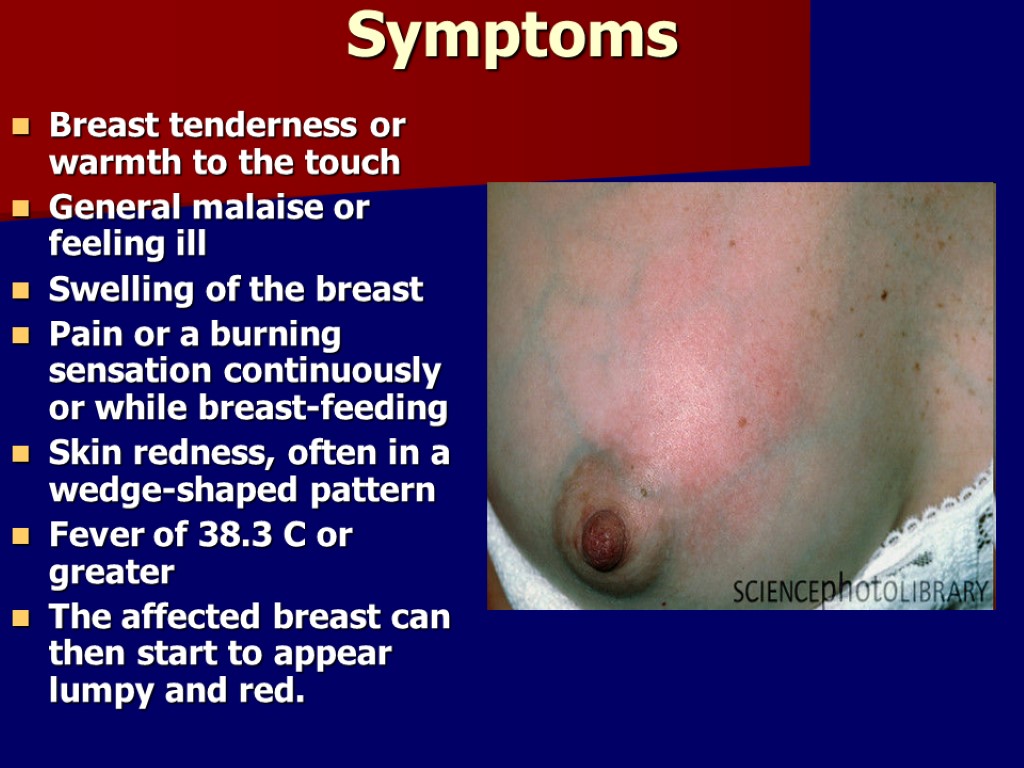 Symptoms Breast tenderness or warmth to the touch General malaise or feeling ill Swelling
